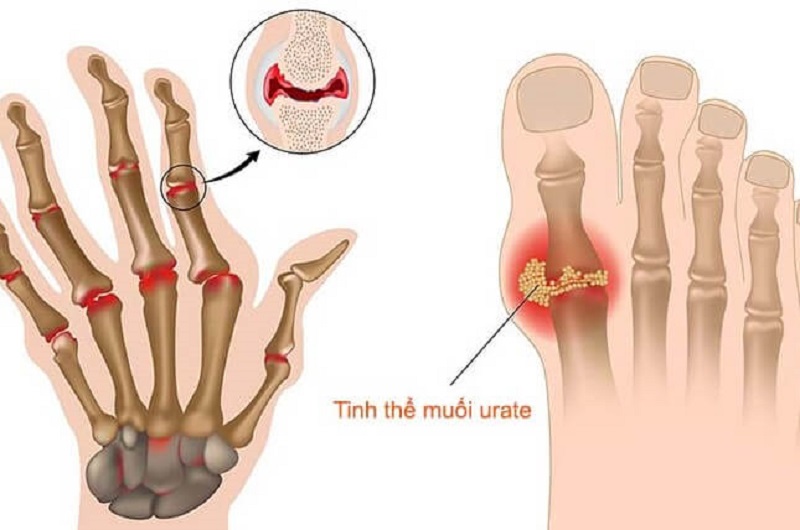 Rối loạn chuyển hóa cần được phát hiện và điều trị từ sớm